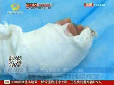 岳阳：两幼童嬉闹 手指被剪断
