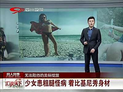 [视频]少女患粗腿病穿比基尼秀身材 右腿为常人两倍粗