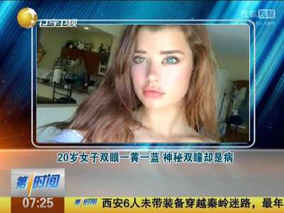 [视频]20岁女子双眼一黄一蓝 神秘双瞳却是病
