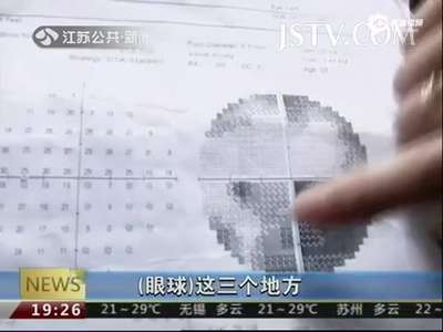 [视频]玻尿酸误打入血管 致面部栓塞眼球部分失明