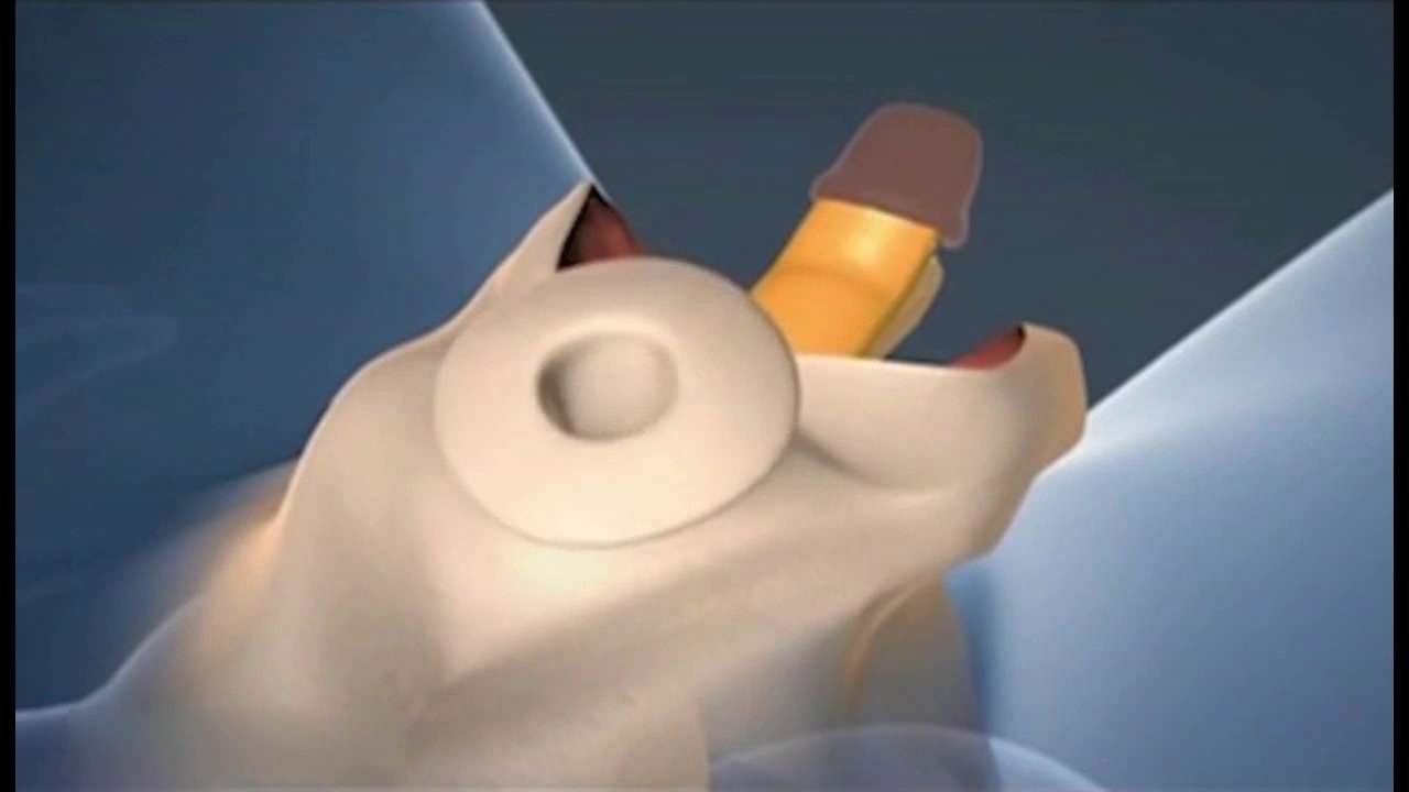 动画展示男变女的性器官手术全程