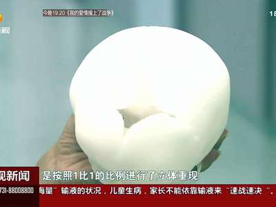 7个月女婴重塑颅骨 3D打印来帮忙