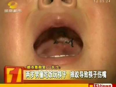 两岁男童吃饭玩筷子 摔跤导致筷子伤嘴