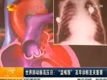 世界肺动脉高压日：“蓝嘴唇”及早诊断至关重要